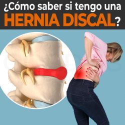 ¿Cómo saber si tengo una hernia discal?