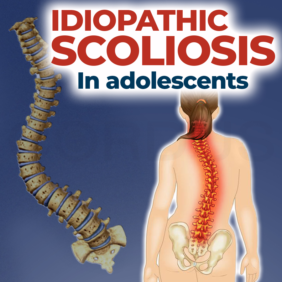 Idiopathic scoliosis (In adolescents)