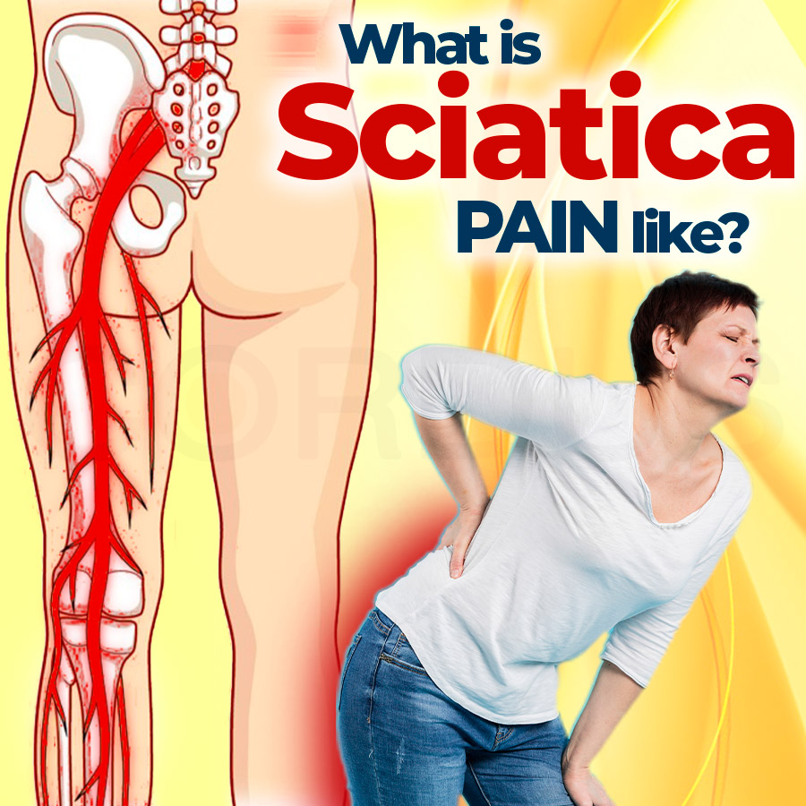 What is sciatica pain like?